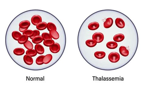 beta thalassemia major|Beta Thalassemia: Symptoms, Causes, Treatment, &  .